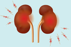 Read more about the article What is Kidney Stone Disease and How to Prevent It