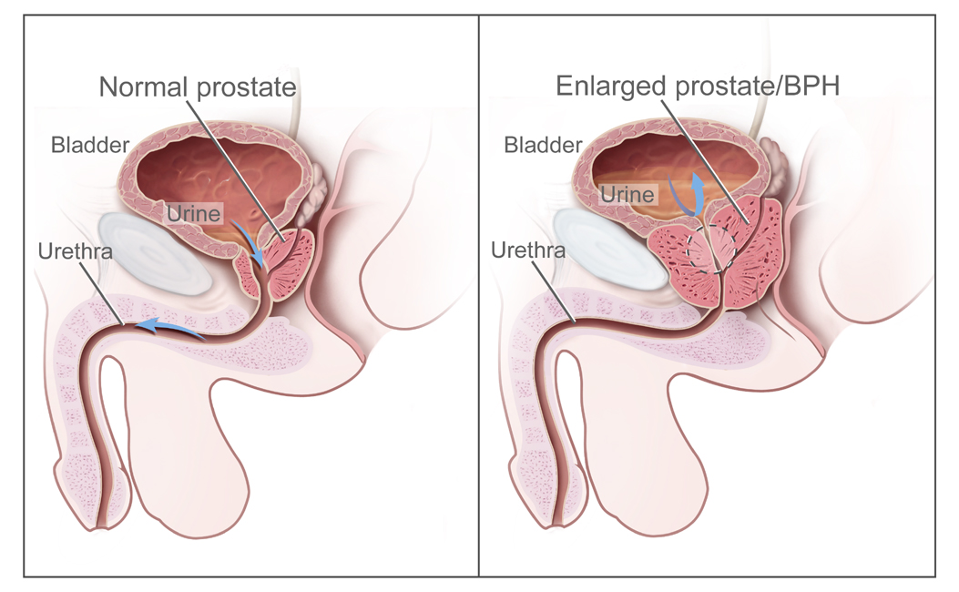 Read more about the article Benign Prostatic Hyperplasia: Symptoms, Causes and Treatments