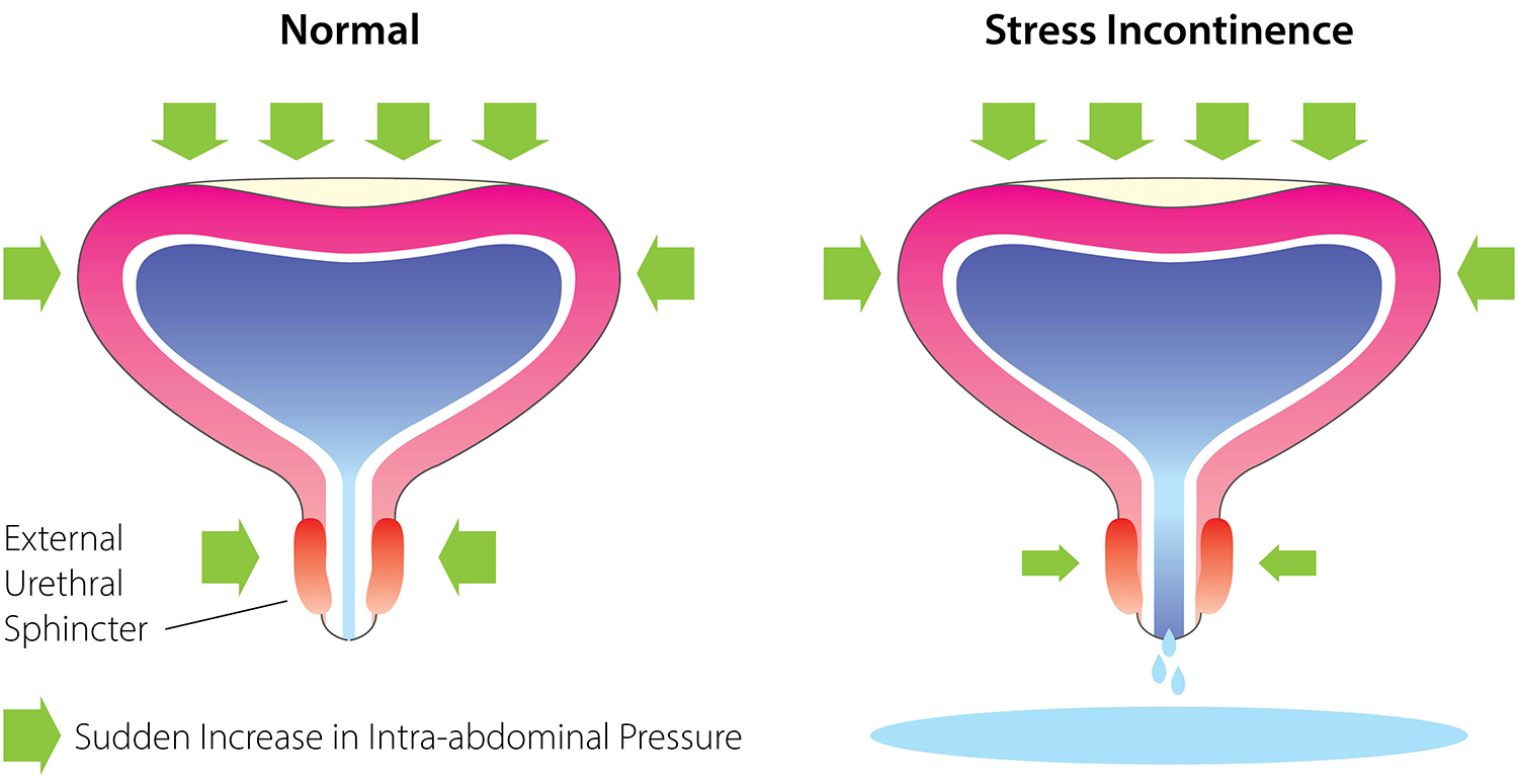 Read more about the article Stress Incontinence: Causes, Symptoms & Treatments