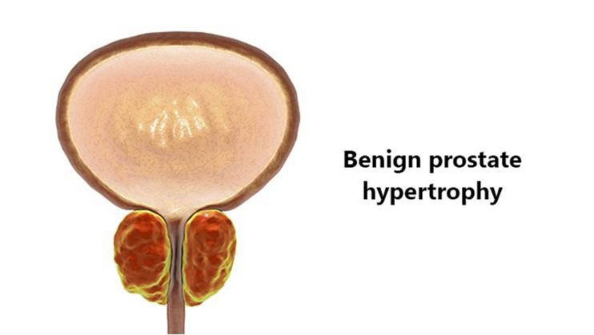 Benign Prostatic Hyperplasia Symptoms Causes And Treatments Rescue Urology Hospital Blog