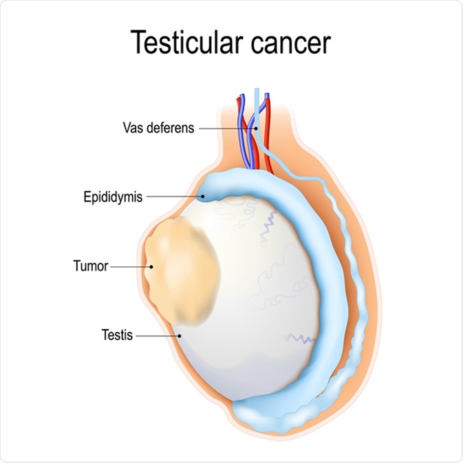 Read more about the article Testicular Cancer: Symptoms, Diagnosis & Treatment