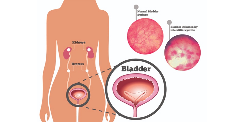 Bladder Pain Syndrome ReSCUE Urology Hospital Blog