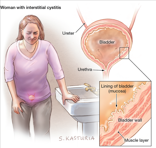 interstitial-cystitis 