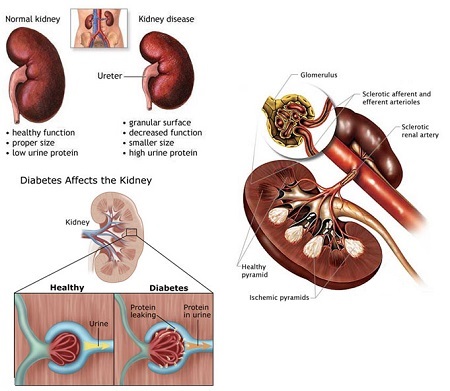 Read more about the article Diabetic Nephropathy